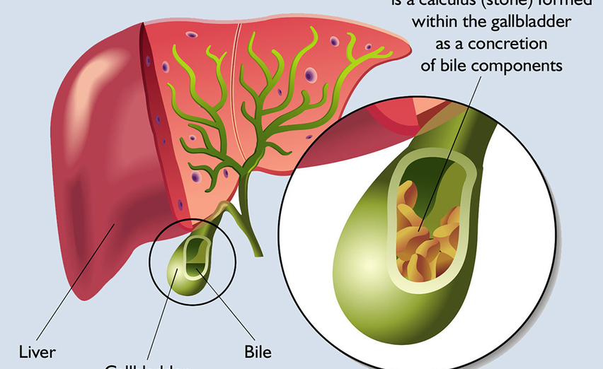 3-Day Liver - Gallbladder Fast Cleanse