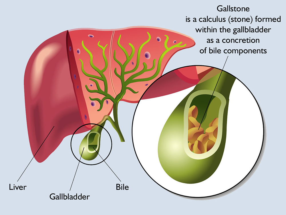 3-Day Liver - Gallbladder Fast Cleanse