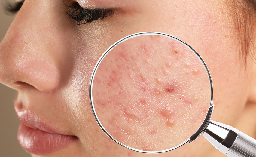 Acne and Lifestyle: How to Lessen Its Effects