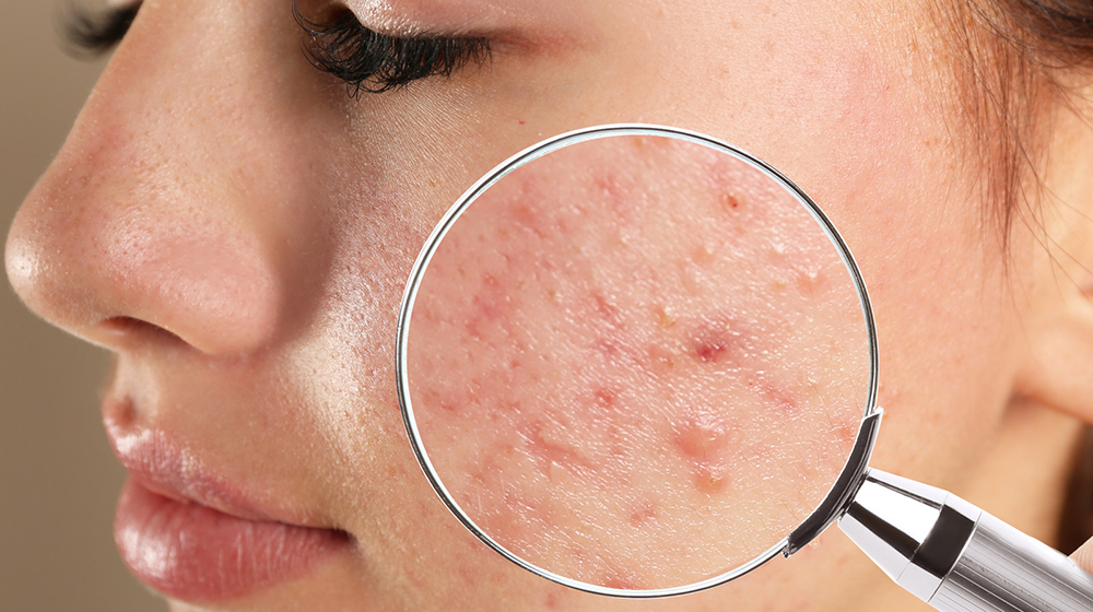 Acne and Lifestyle: How to Lessen Its Effects
