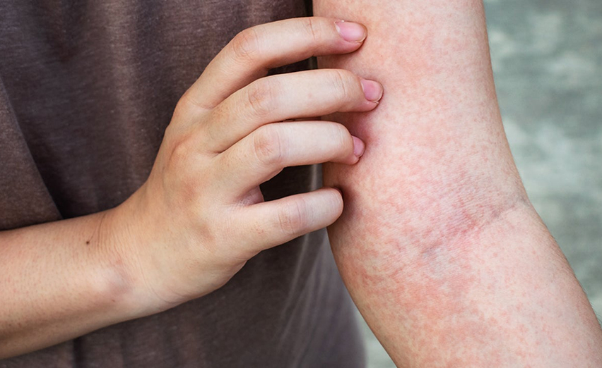 Skin Irritation Protocol