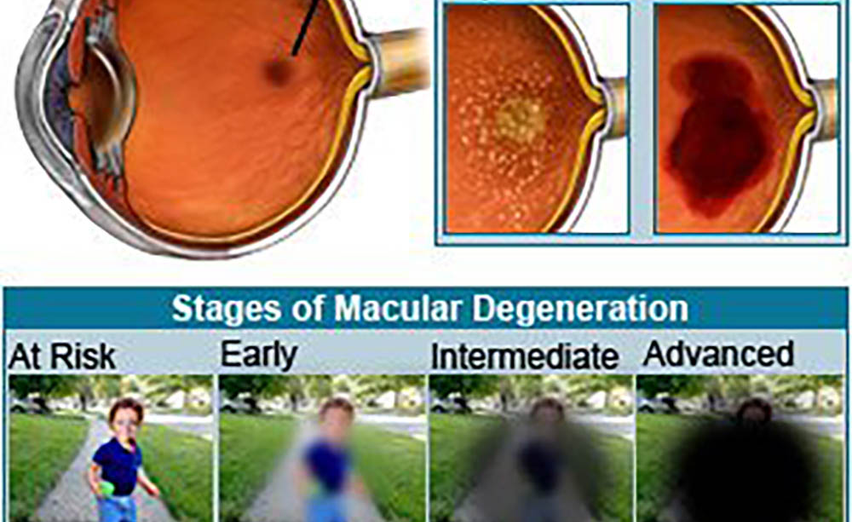 The Link Between Age-Related Macular Degeneration and Gut Health