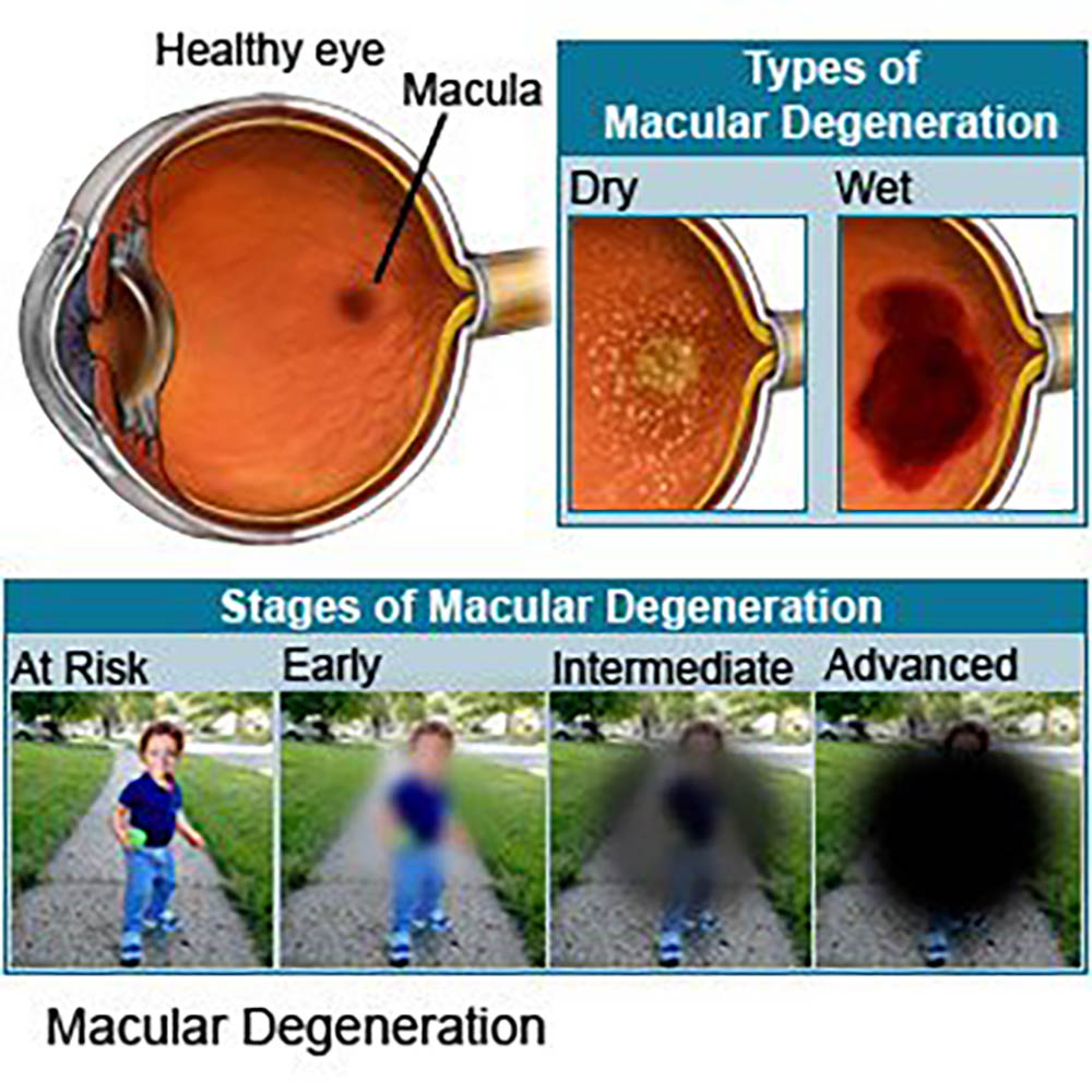 The Link Between Age-Related Macular Degeneration and Gut Health
