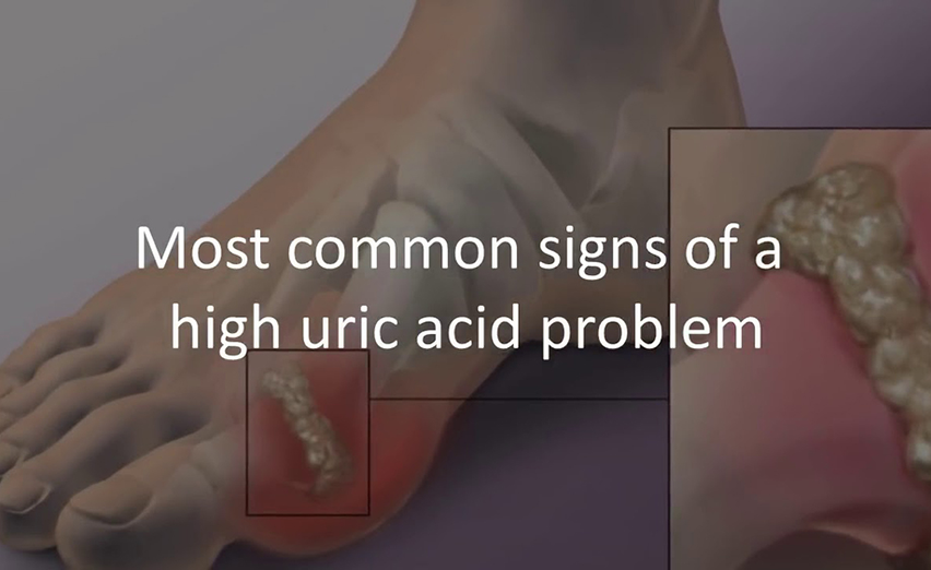 Uric Acid Buildup Protocol