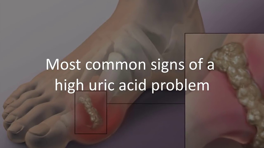 Uric Acid Buildup Protocol