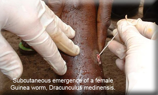Guinea Worm
